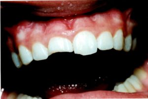  Chipped Tooth - Before