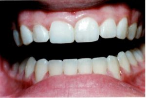  Chipped Tooth - After