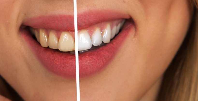 The Best Ways to Whiten Your Teeth The Best Ways to Whiten Your Teeth