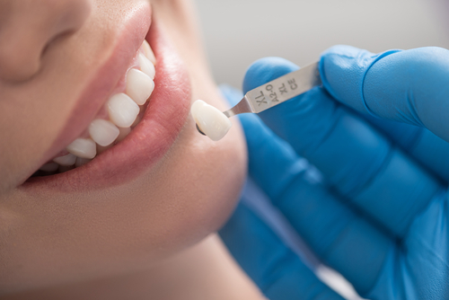 Different Types of Dental Crowns and Why You Need Them